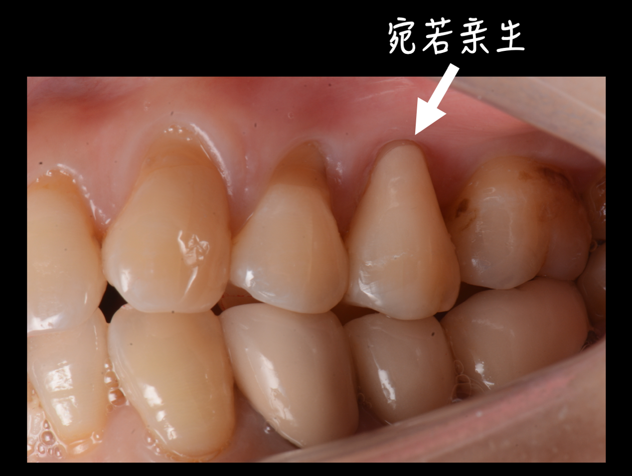 硬度堪比钻石,却为何那么容易受伤?