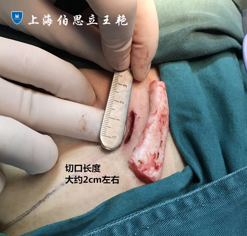 肋软骨隆鼻疤痕详解