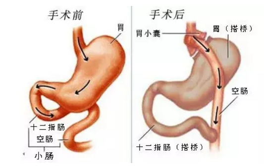 胃手术方式图片
