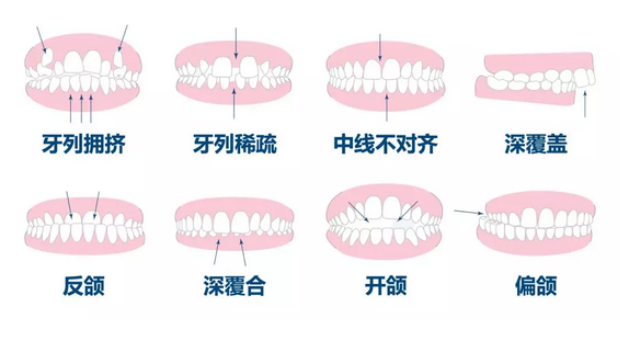 深覆合是由什麼原因引起的?該如何矯正?