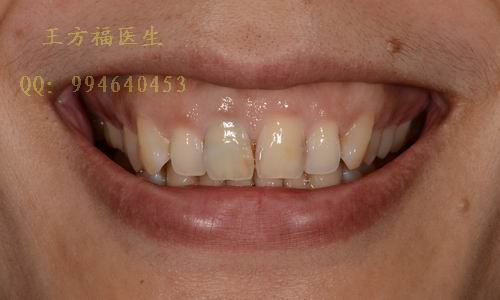 高位笑线,邻面龋-瓷贴面修复病例 /三亚王方福医生