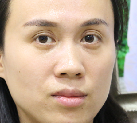 当时面诊李女士的时候,她的三眼皮情况很严重,致使她的面部五官显