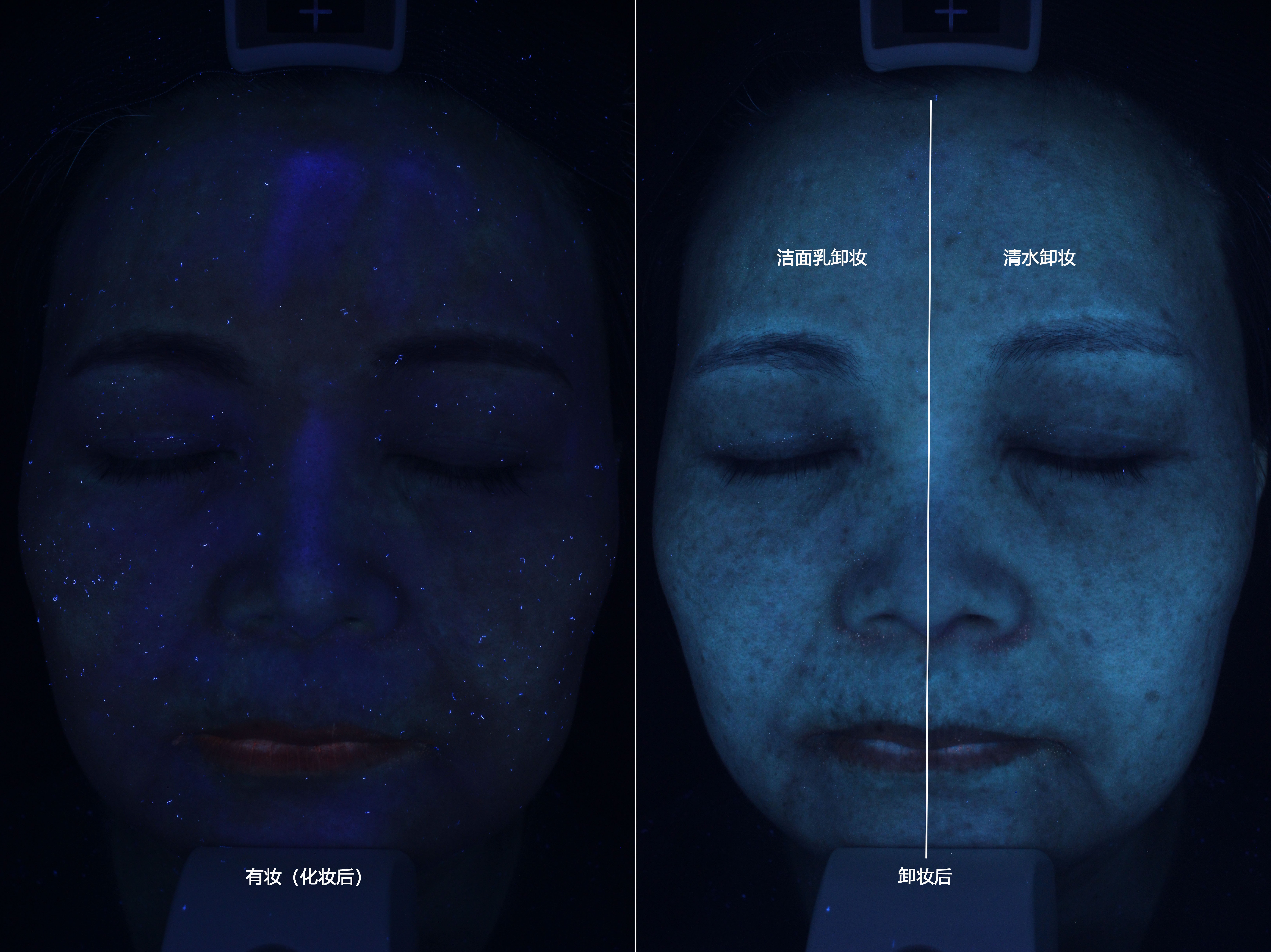 visia紫质对比:化妆后的皮肤上有很多杂质;卸妆后,杂质彻底消失,但