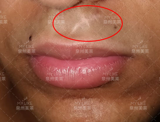 我今年20岁,请问上唇缝合后的疤痕用什么方法去掉最好?