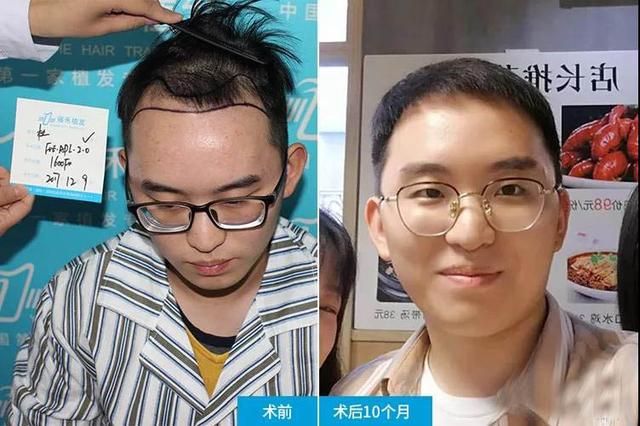 25岁小伙植发2000单位女朋友愣是说他没植发