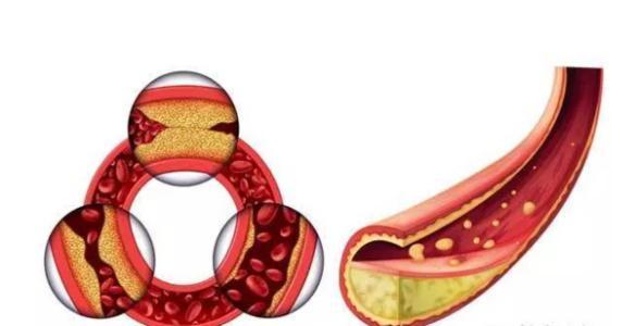 甘油三酯多少才算正常2个方法降甘油三酯远离高血脂