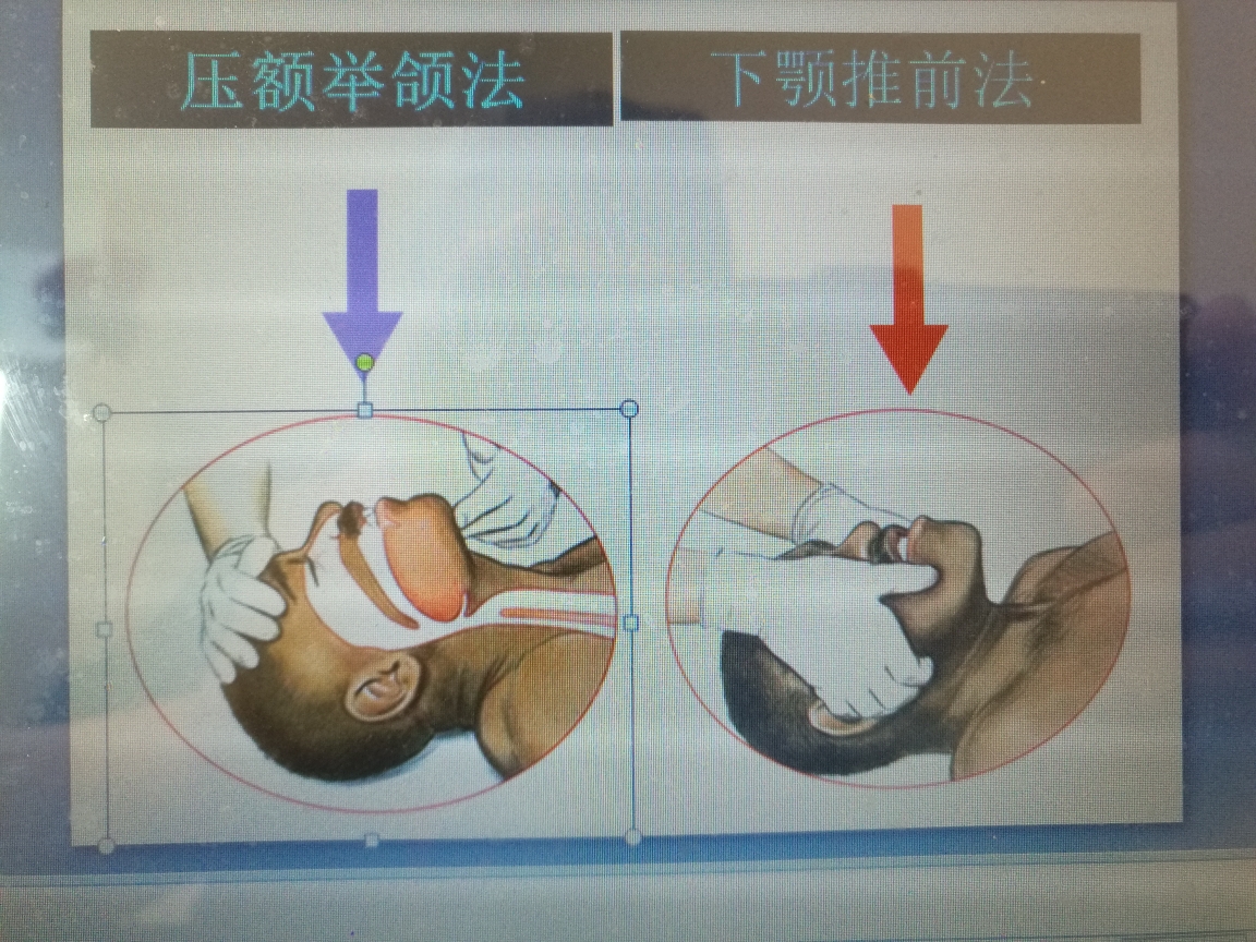 3  口对口吹气基于最新心肺复苏指南,按压30次吹气2次的复苏方法,以及