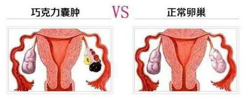 即可成为子宫内膜异位症,这种异位的内膜在组织学上不但有内膜的腺体