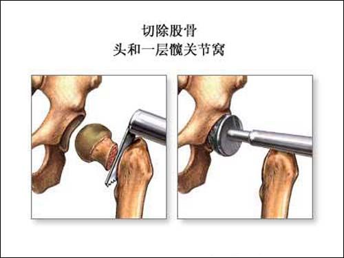 为什么行髋关节置换术
