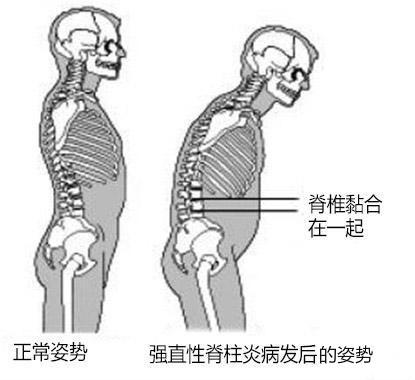 强直性脊柱炎走路姿势图片