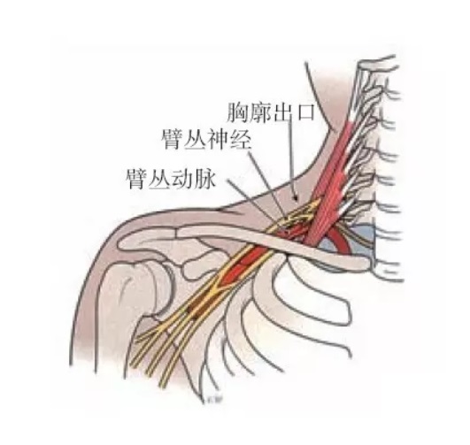 图2,周围结构受损时,胸大肌附着点可能压迫臂丛神经,同样可以表现出