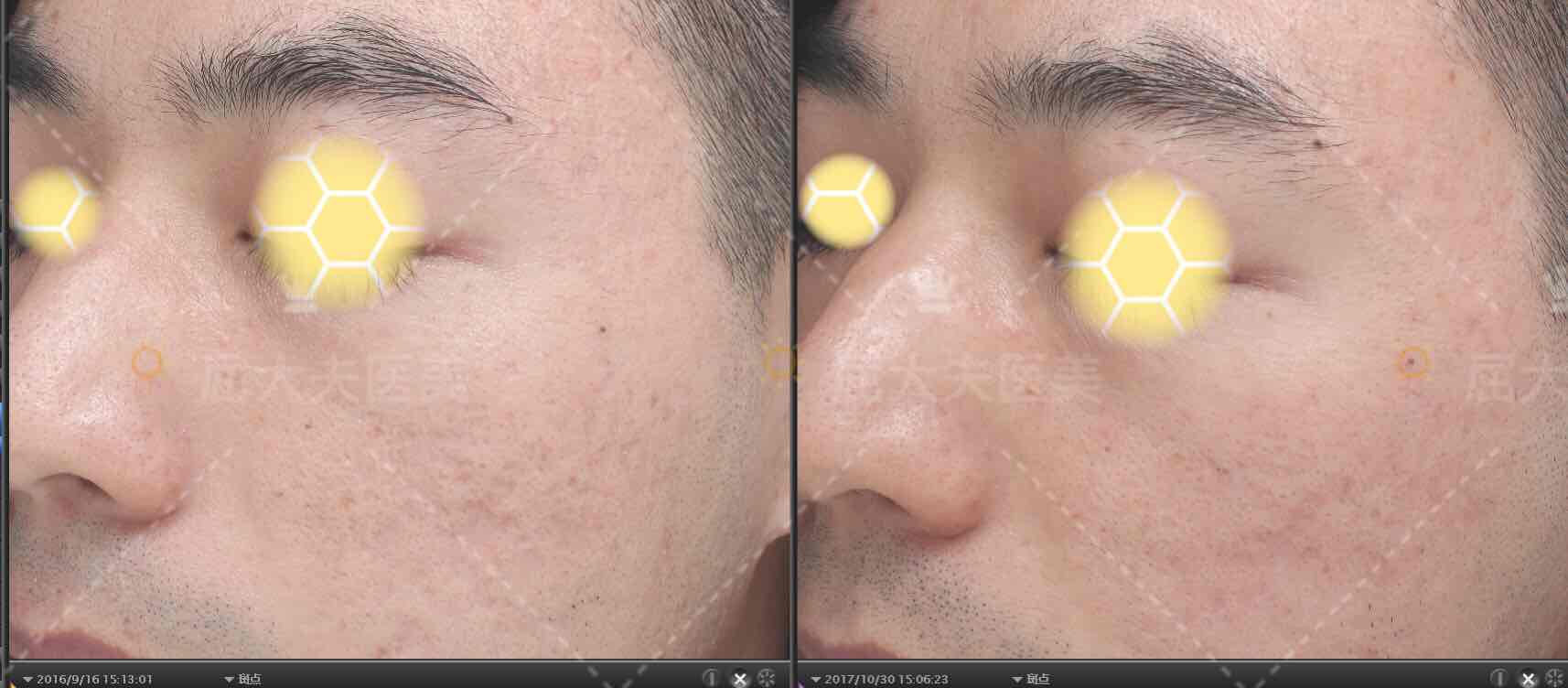 皮下分离和飞梭治疗痤疮凹坑