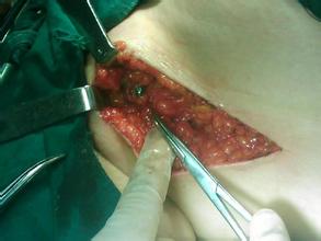 术中在腋下作一小切口,准确地将追踪到最先染色的淋巴结,送病理检查