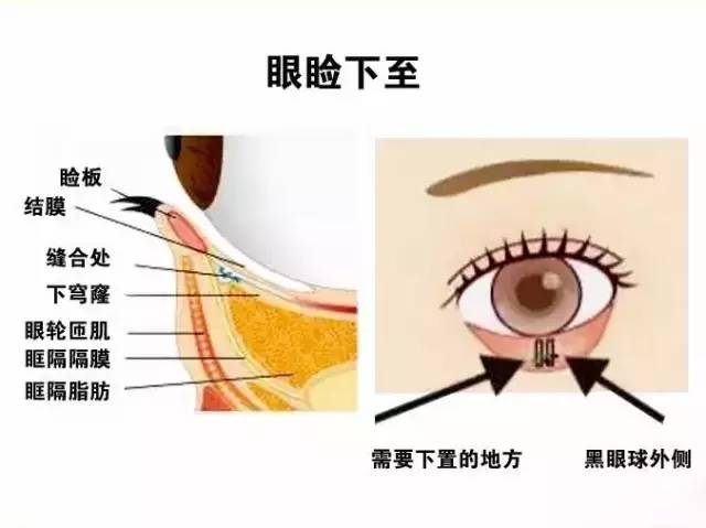 但是要告诉大家的是,如果手术把握不当,会造成下睑内翻和眼睛闭合不良