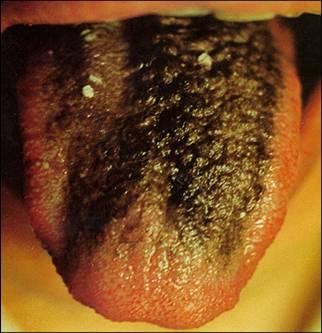 舌头上有黑斑图片图片