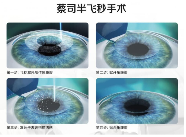 激光近视手术和icl手术有什么区别 Eeyoreeleven 新浪博客