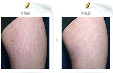 夏天都到了你的肥胖纹解决了吗