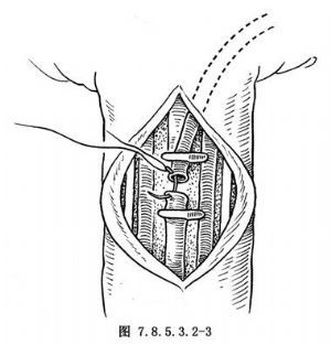 男性延时埋线手术图片