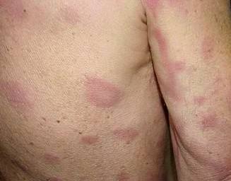 远在天边的麻风病