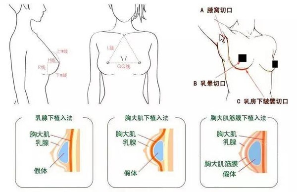 你担心的假体隆胸后遗症包膜挛缩