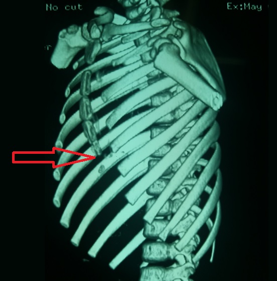 图2,前胸壁凹陷明显,心脏受压明显图1,前胸壁明显凹陷
