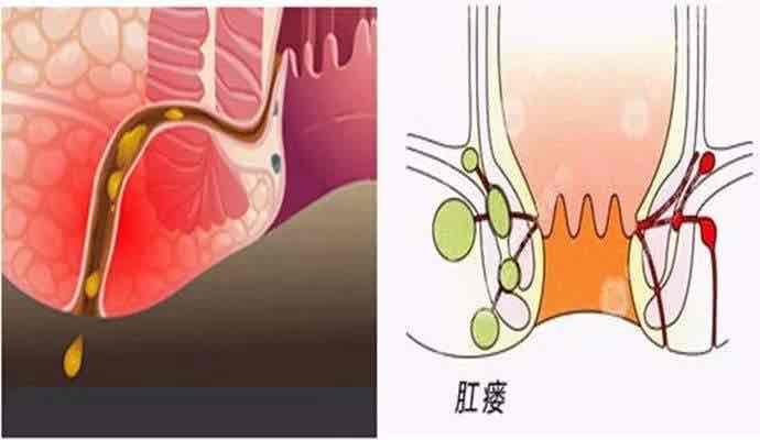 長大後我就成了你肛瘻與肛周膿腫的深情對唱