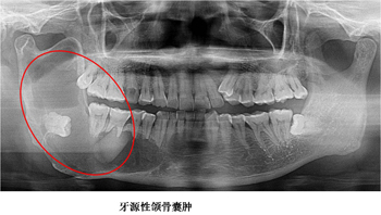 由智齿引起的牙源性颌骨囊肿,严重的导致下颌骨局部手术切除,严重影响