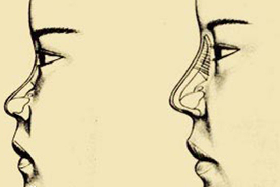 关于鞍鼻的最全讲解