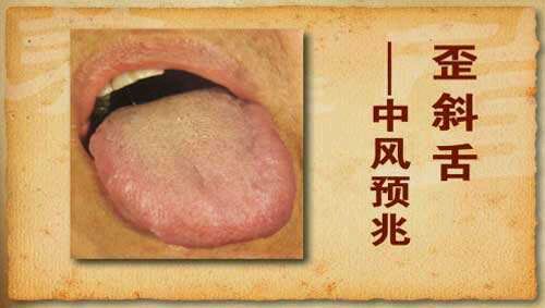 ③痿软:舌体伸卷无力,多因气血俱虚筋脉失养所致.