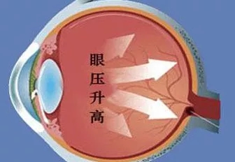 为什么青光眼患者会有发作性虹视呢?-韩崧-爱问医生