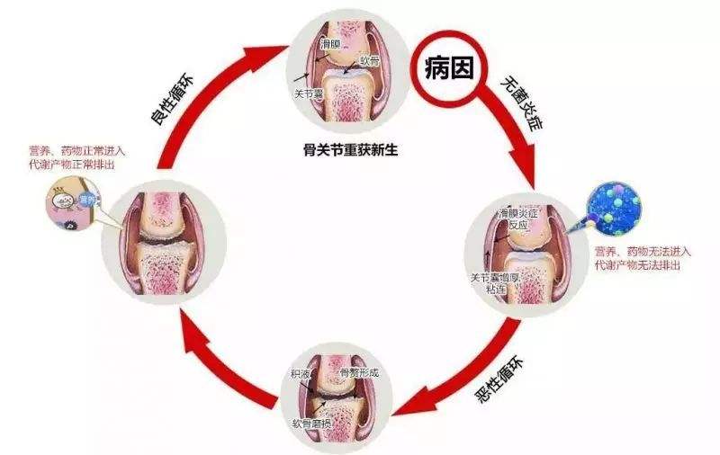 关节肿痛晨僵警惕类风湿性关节炎