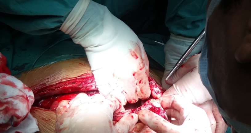 wang手术伟大实战:成人重度胸廓畸形合并重度心脏病一期手术