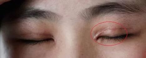 焱秋说眼|双眼皮最难看的不是菜刀割的肉条,而是闭眼凹陷型疤痕