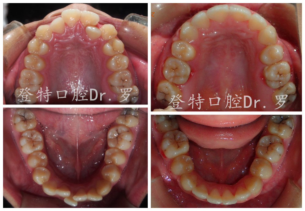 从路人到明星脸,牙齿矫正是怎么做到的?