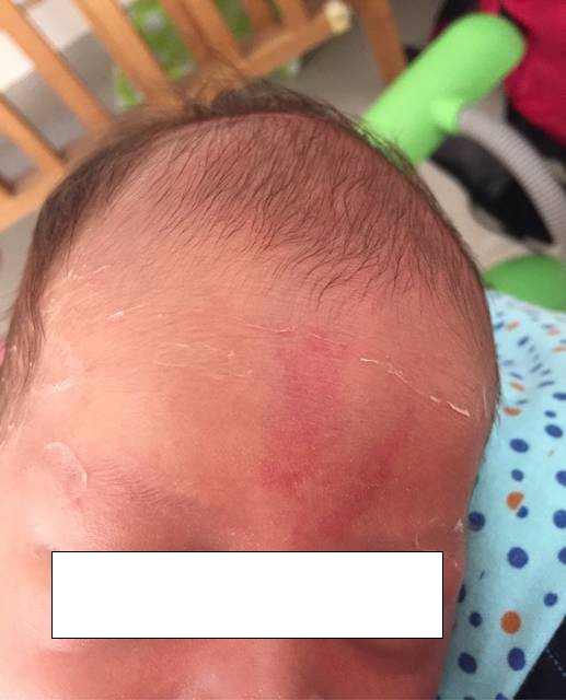 鲜红斑痣:又叫"葡萄酒色样痣"或"毛细血管扩张",表现为淡红,暗红或