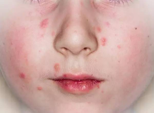 宝宝发烧,长口腔溃疡,千万别当成「上火」!