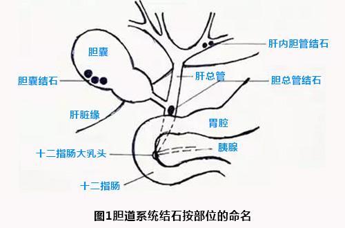 什么样的饮食爱得结石?得了结石怎么吃?医生告诉这样来注意