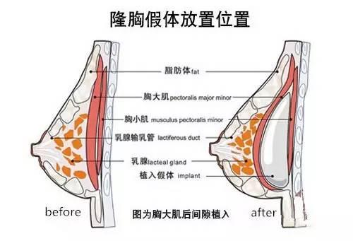 假體隆胸對人體有害嗎尤其是未婚女性