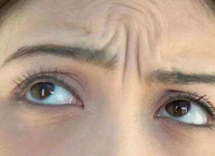 的不断加深,动态皱纹会在面部形成"记忆力",逐渐形成褶皱变成静态皱纹