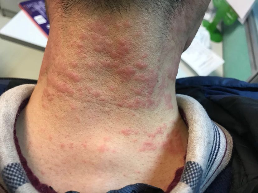 大家贴膏药一般贴多长时间有的人说不能超过12个小时有的人说单次不能