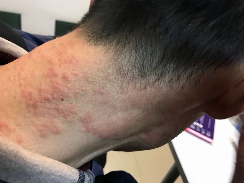 大家贴膏药一般贴多长时间,有的人说不能超过12个小时,有的人说单次不