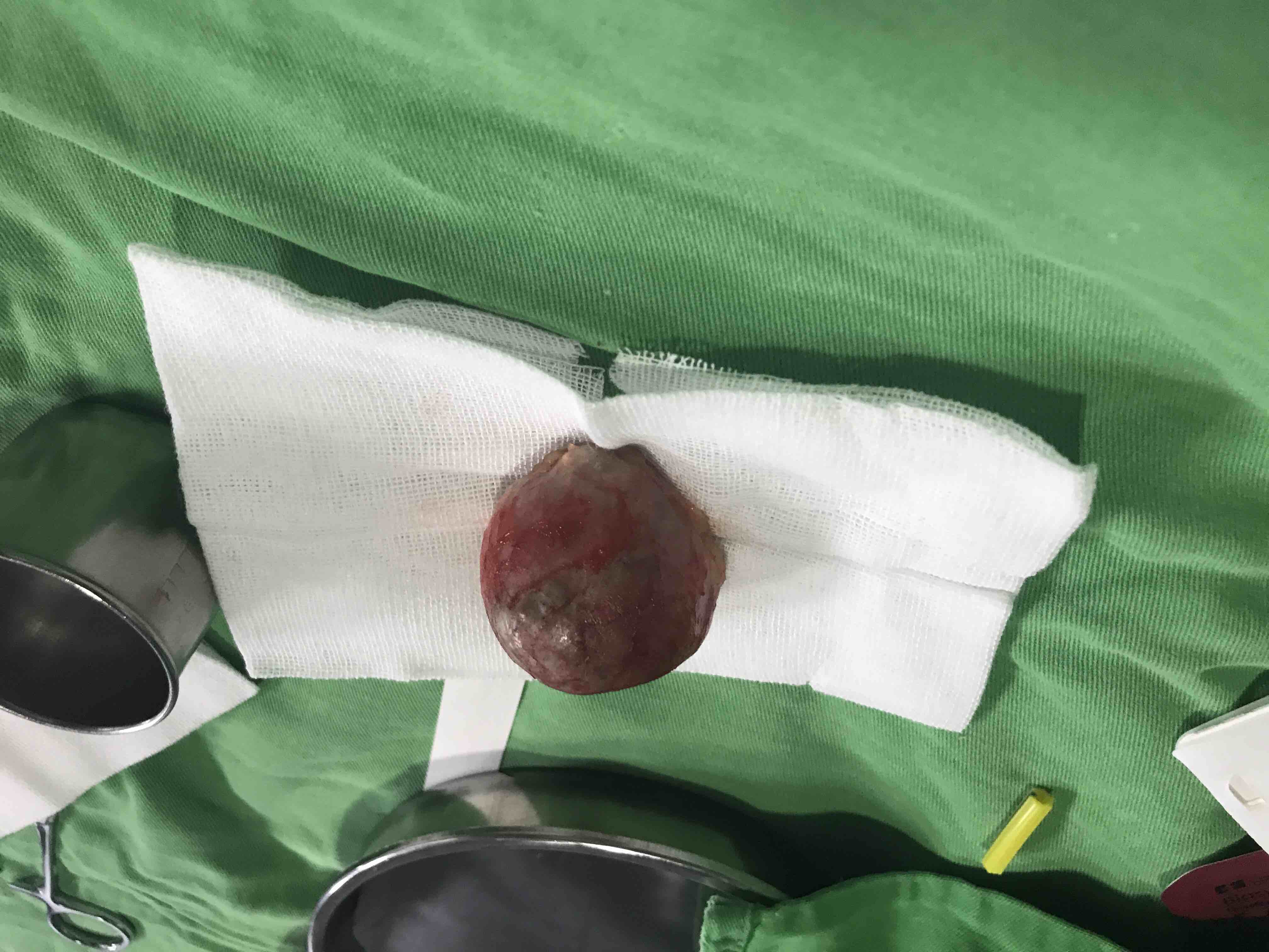 巨大皮脂腺囊肿