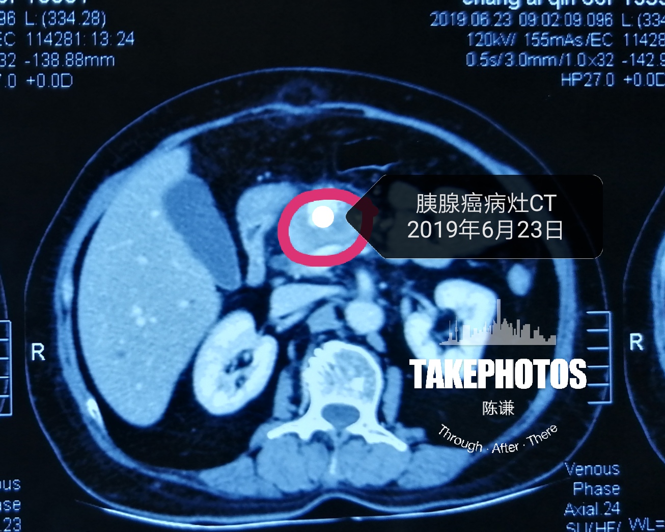 胰腺癌彩超图片