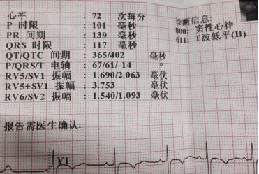 "医生,我在体检单上发现自己患有窦性心律,是不是心脏有问题?