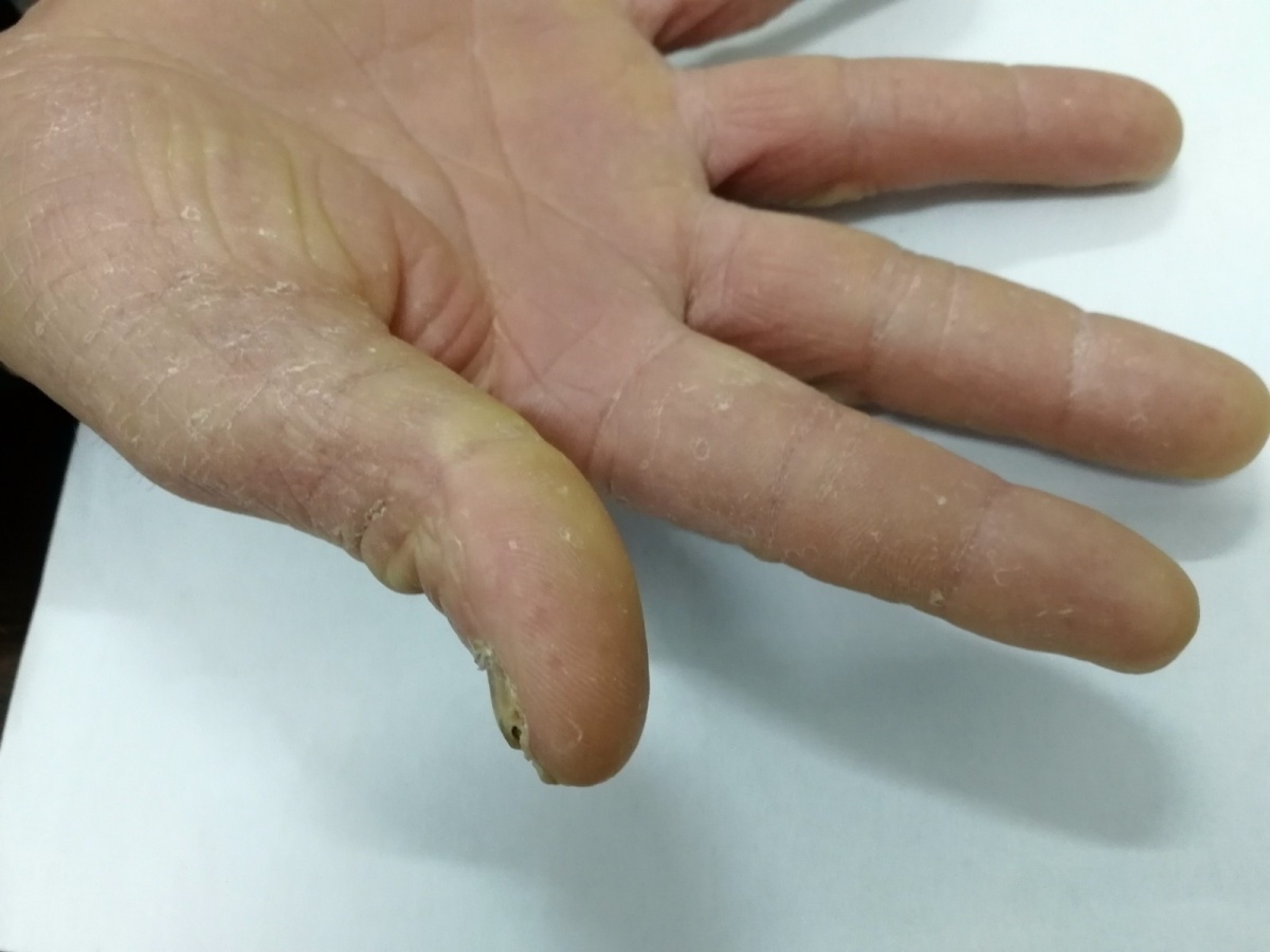 剥脱性角质松解症:皮损表现主要是表皮剥脱,无明显水疱,一般不痒.
