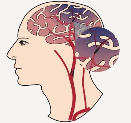 脑梗塞是不是一定会导致偏瘫