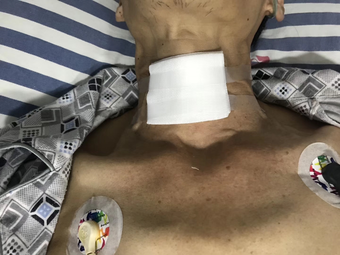 环甲膜穿刺案例