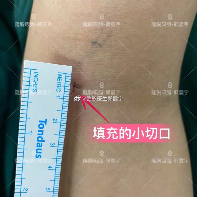 假体隆胸的切口位置可选择:腋下切口,乳晕切口,乳房下皱襞切口和肚脐