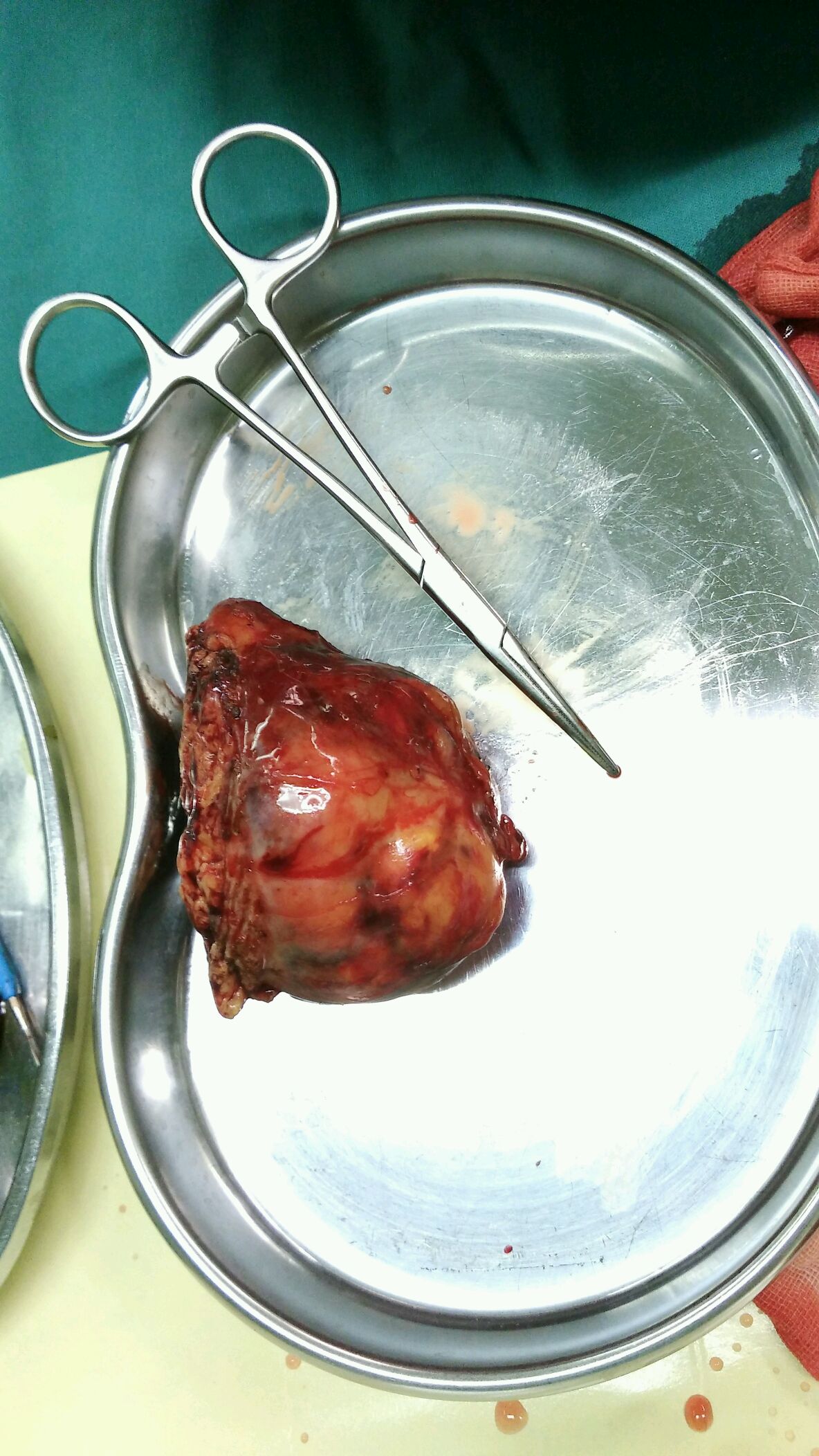 男,55岁,右肾下极8cm血管平滑肌脂肪瘤.开放手术右肾部分切除术.