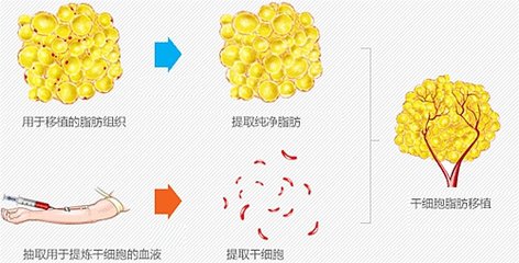 自体脂肪手术不是简单的抽指和注入,高吸收,严重感染等并发症源于关键